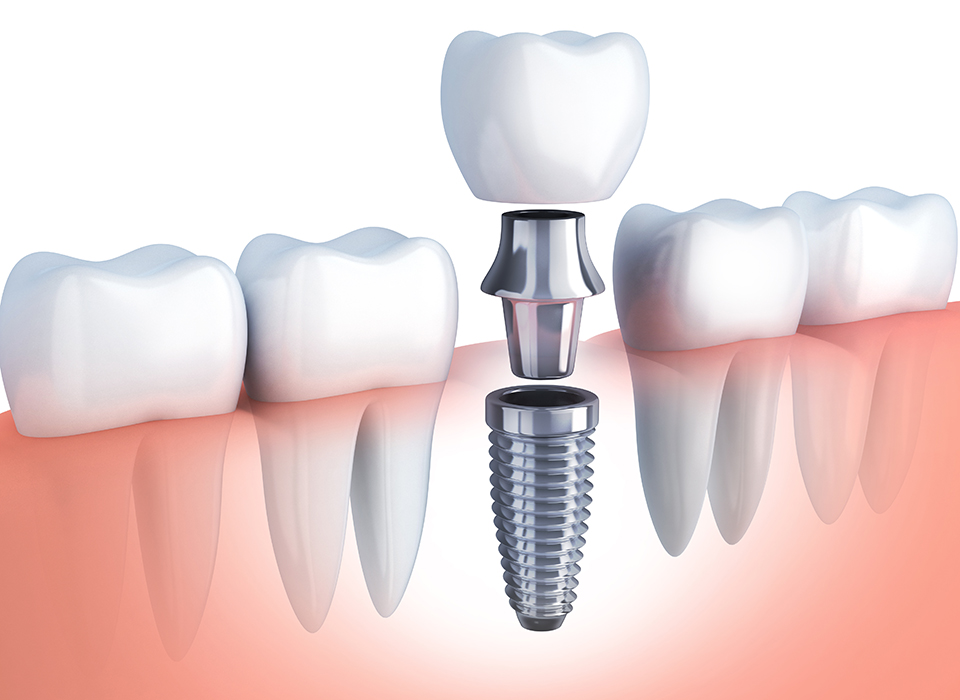 L'Importance de la Dentisterie Esthétique, Pédiatrique et Préventive avec une Touche d'Innovation des Implants Dentaires Tunisie